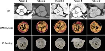 Transcatheter aortic valve replacement in patients with quadricuspid aortic valve in a single center